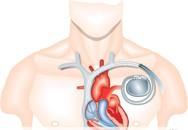 ЕМС тренировки для похудения. Что это такое, упражнения, отзывы врачей, фото до и после